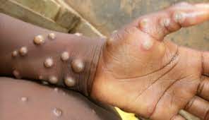 Nigeria Records 21 Additional Cases Of Monkey Pox  